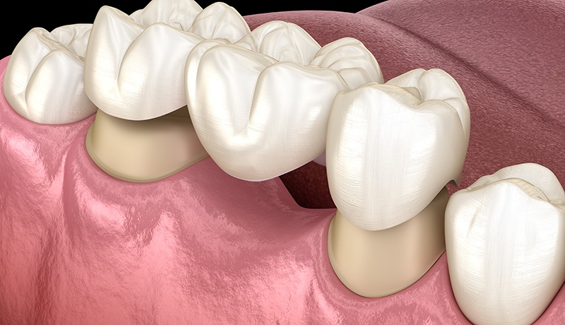 A dental bridge closes gaps in your arches with a natural looking dental prosthetic