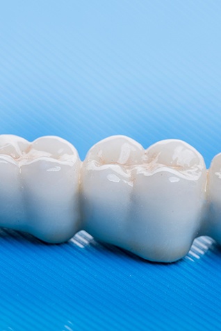 A dental bridge is a prosthetic tooth replacement