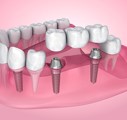 Implant bridges are a permanent tooth restoration solution