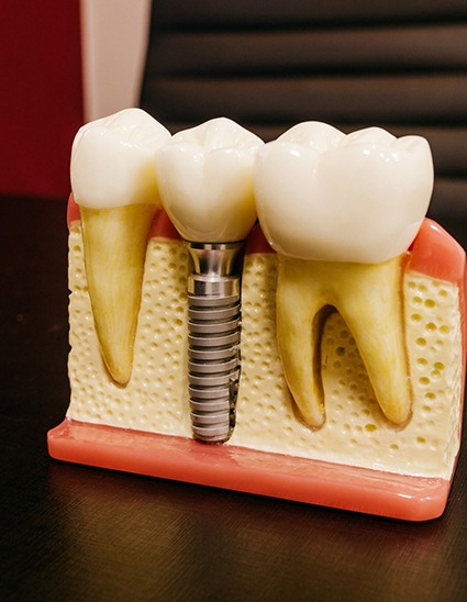 Model of dental implant replacing a lost tooth
