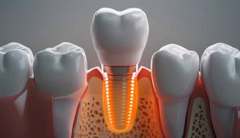 a 3D illustration of a failed dental implant